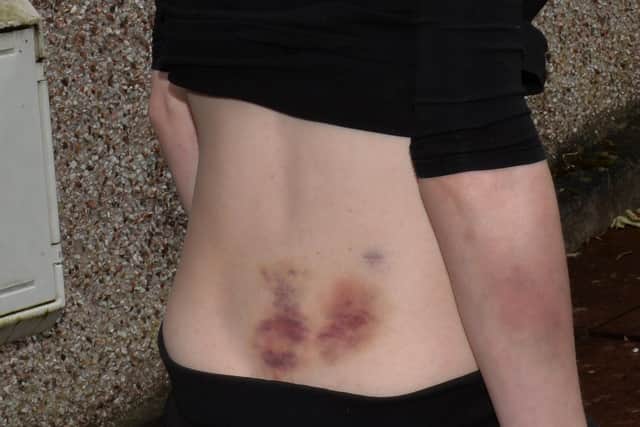 Bruising to Jessica's back and one of her arms.