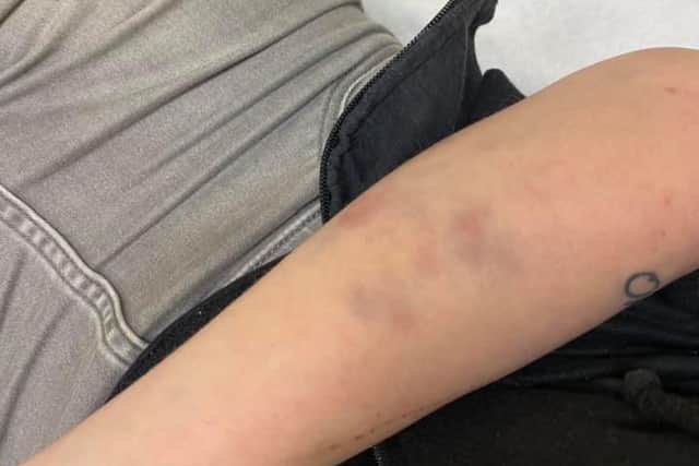Bruising to one of Jessica's arms.