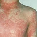 Borderers are being asked to be aware of symptoms of Scarlet Fever.