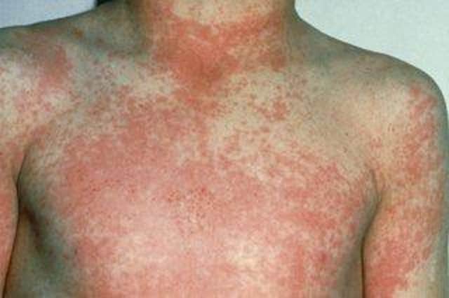 Borderers are being asked to be aware of symptoms of Scarlet Fever.