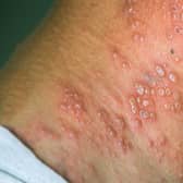 Shingles can prove very painful.