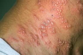 Shingles can prove very painful.